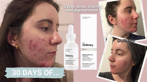 30 DAYS OF…The Ordinary Niacinamide and Zinc | ONE MONTH REVIEW - YouTube