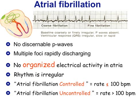 Afib vs a flutter - Dervirgin