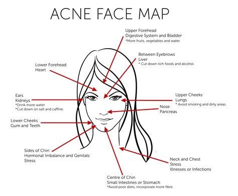 What does your Acne reveal about your health — HealthDigezt.com