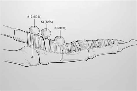 Flexor Tendon Sheath Cyst