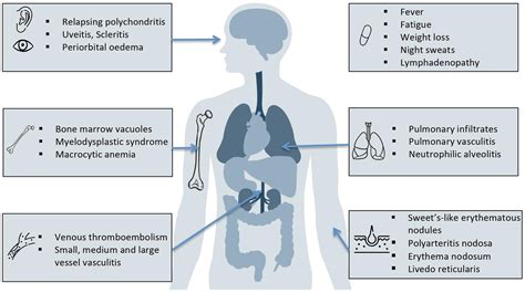 VEXAS syndrome (vacuoles, E1 enzyme, X-linked, autoinflammatory, somatic) for the dermatologist ...