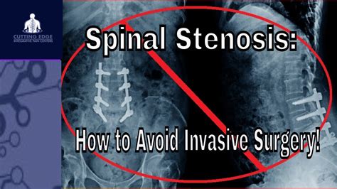 Treatment For Lower Lumbar Spinal Stenosis: Minimally Invasive Lumbar Decompression ( New 2020 ...