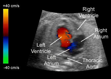 Fetal Echo: Color Doppler