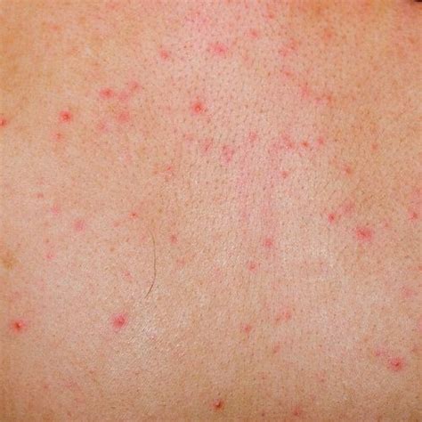 17 Lice Symptoms with Pictures: Signs That You Have Head Lice - My Lice Advice