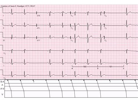 ECG Lecture: Sinus arrest, sinoatrial exit block, AV block and escape…