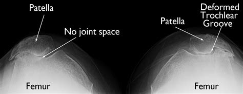 Patellofemoral Arthritis - OrthoInfo - AAOS