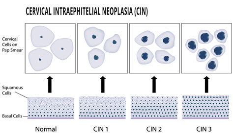 Abnormal Pap Smear Tests: Causes, Symptoms, & Treatment