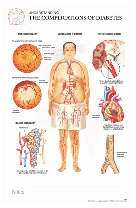 Body Scientific International Post-it Complications of Diabetes Chart