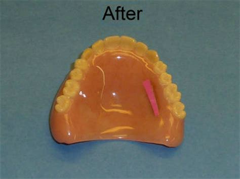 Dentures Repairs - Academy Denture Clinic