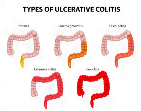 Ulcerative Colitis (UC): Causes, Symptoms, Types, Diagnosis & Treatment ...