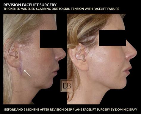 Revision Facelift | Dr. Dominic Bray