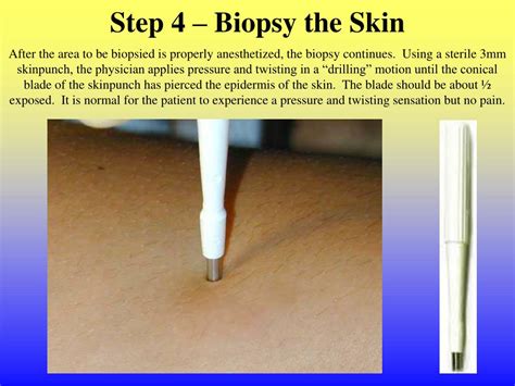 PPT - Johns Hopkins Cutaneous Nerve Laboratory Skin Biopsy Procedure PowerPoint Presentation ...