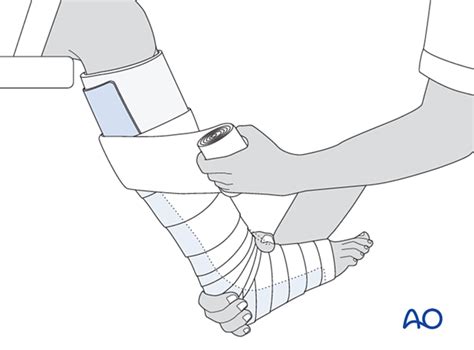 Short leg cast for Epiphysiolysis (Salter-Harris I) of the distal tibia