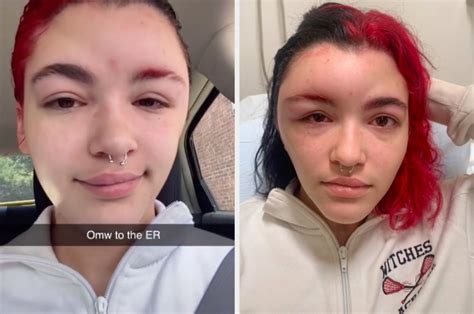 Hair Dye Allergic Reaction: Woman's Story On TikTok