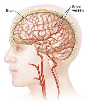 Understanding Cerebral Angiography | Saint Luke's Health System