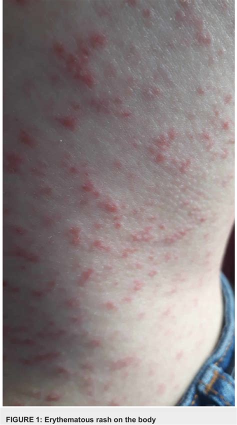 Figure 1 from Coronavirus Disease 2019 (COVID-19) Accompanied by Maculopapular Rash: A Case ...