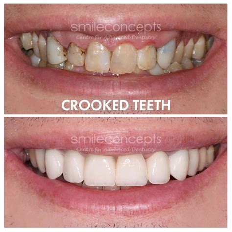 Can I Get Porcelain Veneers If I Have Crooked Teeth? A Case Study