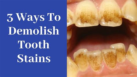 how to get rid of black stains on teeth - dischfaruolo