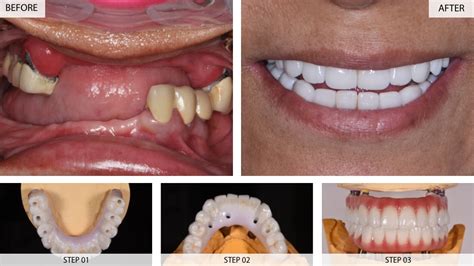 Dental Implants Results (Before & After) - 22 Cases