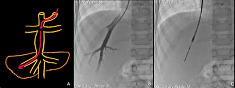 Transjugular liver biopsy for Fontan associated liver disease surveillance: Technique, outcomes ...