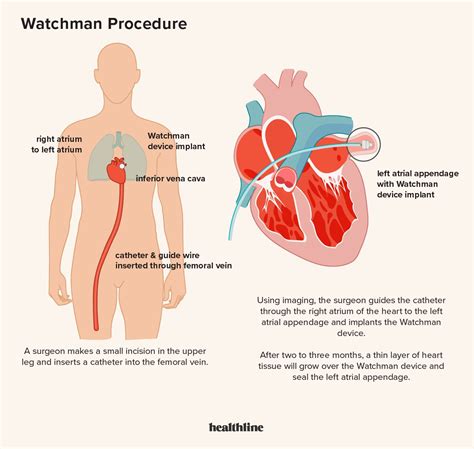 Watchman Procedure for Atrial Fibrillation (AFib): Benefits and Risks