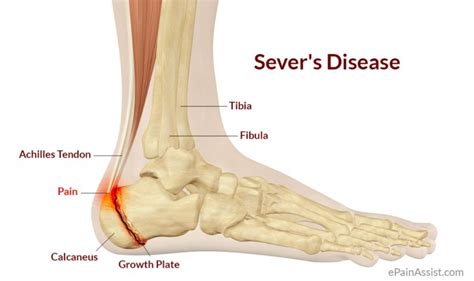 Understanding Sever's Disease And Gymnastics - Allgymnasts.com