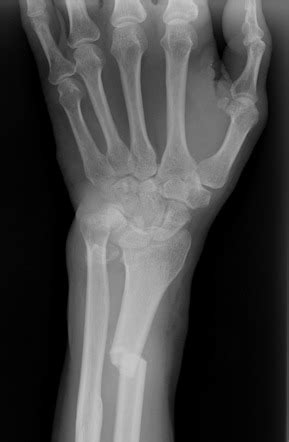 Galeazzi fracture-dislocation | Radiology Case | Radiopaedia.org