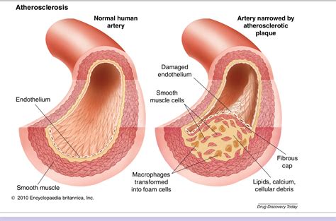 Figure 5 from Excessive intimal hyperplasia in human coronary arteries ...