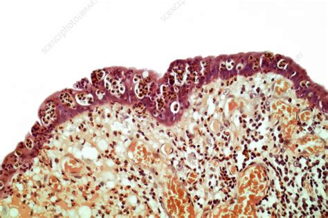 Ulcerative colitis, LM - Stock Image - C058/7835 - Science Photo Library