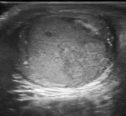 Urinary Tract and male reproductive system | 2.3 Scrotum : Case 2.3.13 Microlithiasis and ...