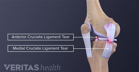 ACL Tear Treatment Options