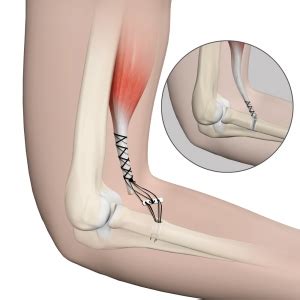 Distal Biceps Repair | Advanced Orthopaedics & Sports Medicine, Orthopaedic Specialists, Cypress ...