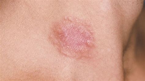 Leukemia Rash Pictures, Signs, and Symptoms | Everyday Health