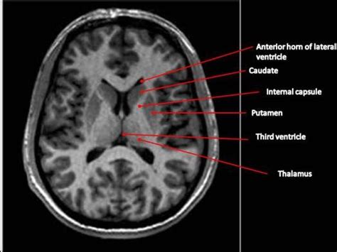 Basal Ganglia Anatomy Ct