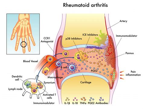 What Are Proinflammatory Cytokines? (with pictures)