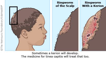 Ringworm Signs, Causes & Treatment (for Teens) | Nemours KidsHealth