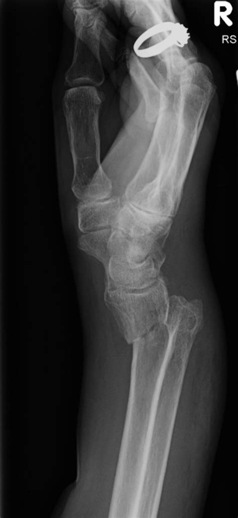 Smith's fracture - Radiology at St. Vincent's University Hospital