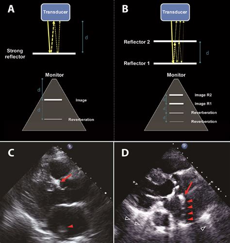 Fact or Artifact in Two-Dimensional Echocardiography: Avoiding Misdiagnosis and Missed Diagnosis ...