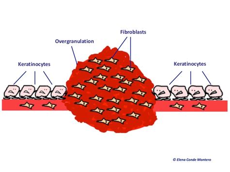 Wound Overgranulation - My New Bum