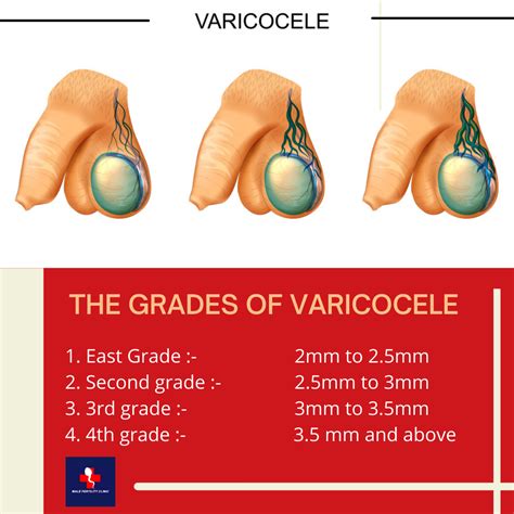 Grades of varicocele- 1. East... - Male fertility Clinic | Facebook