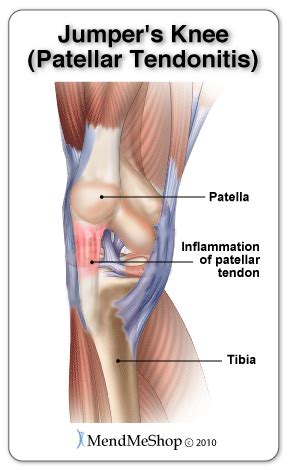 Patellar Tendinitis: Symptoms, Causes, Diagnosis & Treatments