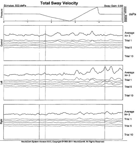 Moving Platform Posturography Testing for Dizziness