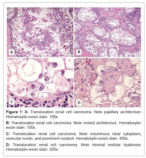 cytology-histology-renal-cell-carcinoma