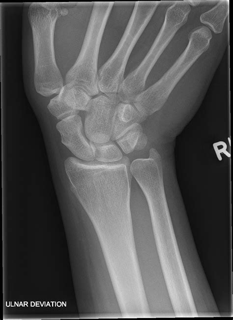 Ulnar X Ray