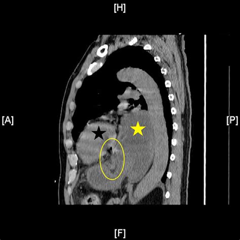 Cureus | Hiatal Hernia With Gastric Perforation