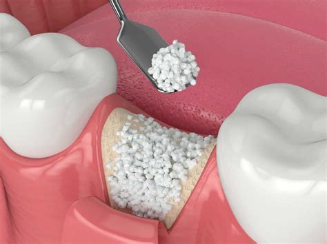 Dental Bone Graft - Bone Graft for Dental Implant