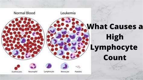 Elevated Lymphs Absolute: Exploring the Causes - JoyAnswer.org