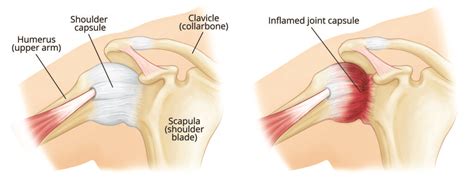 Arthroscopic Capsular Release Cleveland Shoulder Institute