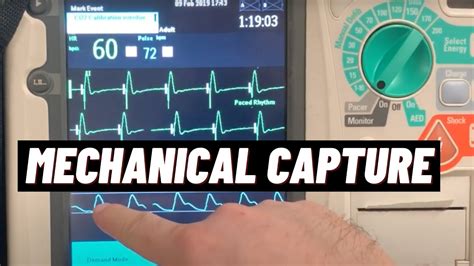 How to Confirm Mechanical Cardiac Capture for Transcutaneous Pacing TCP on Philips HeartStart ...