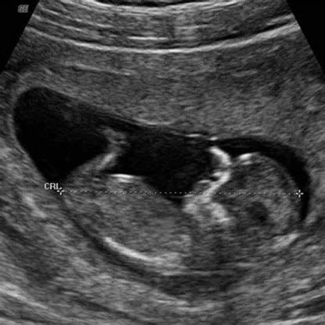 First Trimester Ultrasound Pictures (2024)